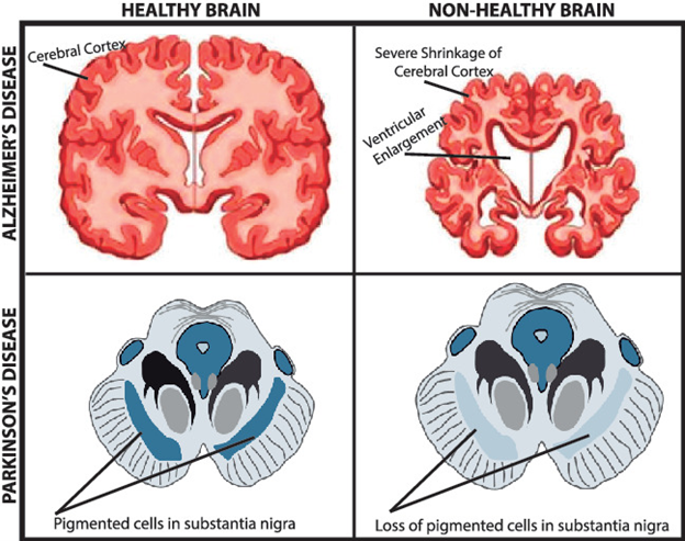 Investigando a Fronteira: O Papel dos Peptídeos de Pesquisa no Alzheimer e Parkinson Image